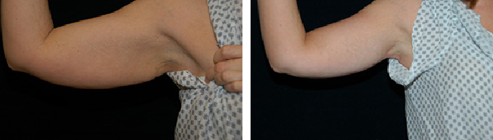 Before and After arm lift Tennessee