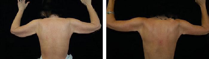 Before and After arm lift Tennessee