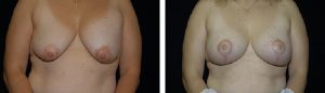 Before and After Breast Revision Tennessee