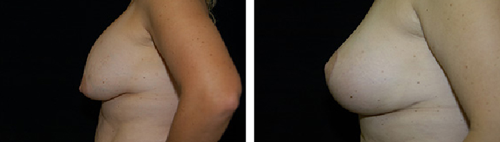 Before and After Breast Revision Tennessee