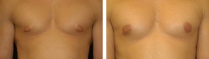 Before and After Male Breast Reduction Tennessee