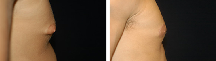 Before and After Male breast reduction Tennessee