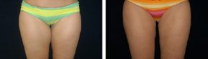 Before and After liposuction Tennessee