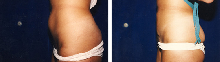 Before and After liposuction Tennessee