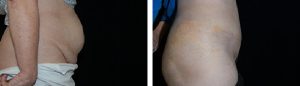 Before and After Tummy Tuck Tennessee