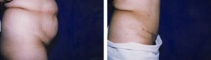 Before and After Tummy Tuck Tennessee
