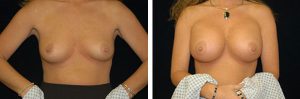 Before and After breast augmentation Tennessee