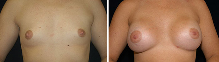 Before and After breast augmentation Tennessee