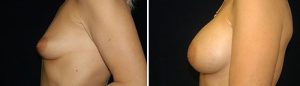 Before and After Breast Augmentation Patient 4 Front View