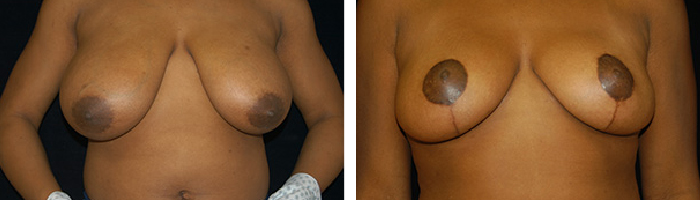 Before and After breast lift Tennessee