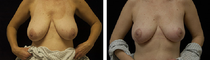 Before and After breast lift Tennessee
