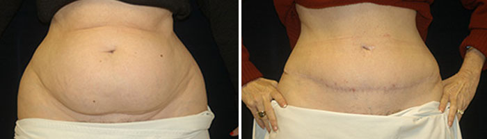 Before and After tummy tuck Tennessee