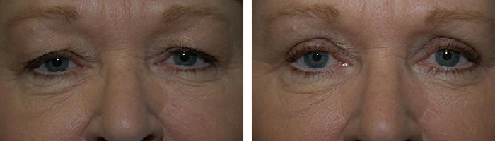Before and After Eyelid Lift Tennessee