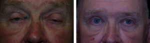 Before and After Eyelid Lift Tennessee