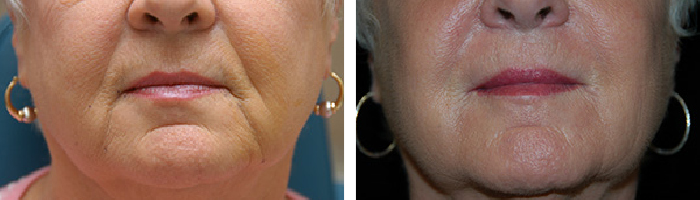 Before and After Fillers Tennessee