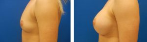 Before and After Breast Augmentation Tennessee