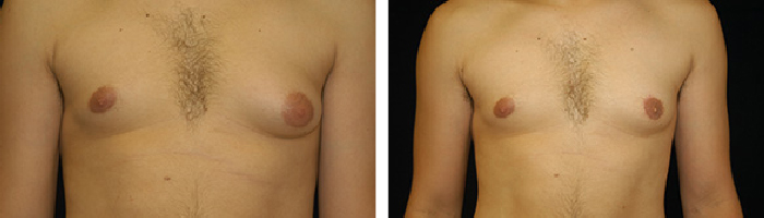 Before and After Male Breast Reduction Tennessee